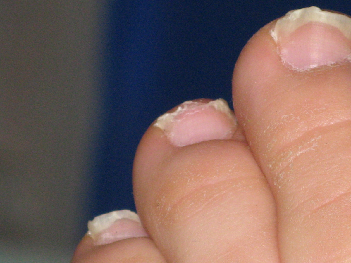 Toenail vs. Fingernail Fungus: Are They Different?